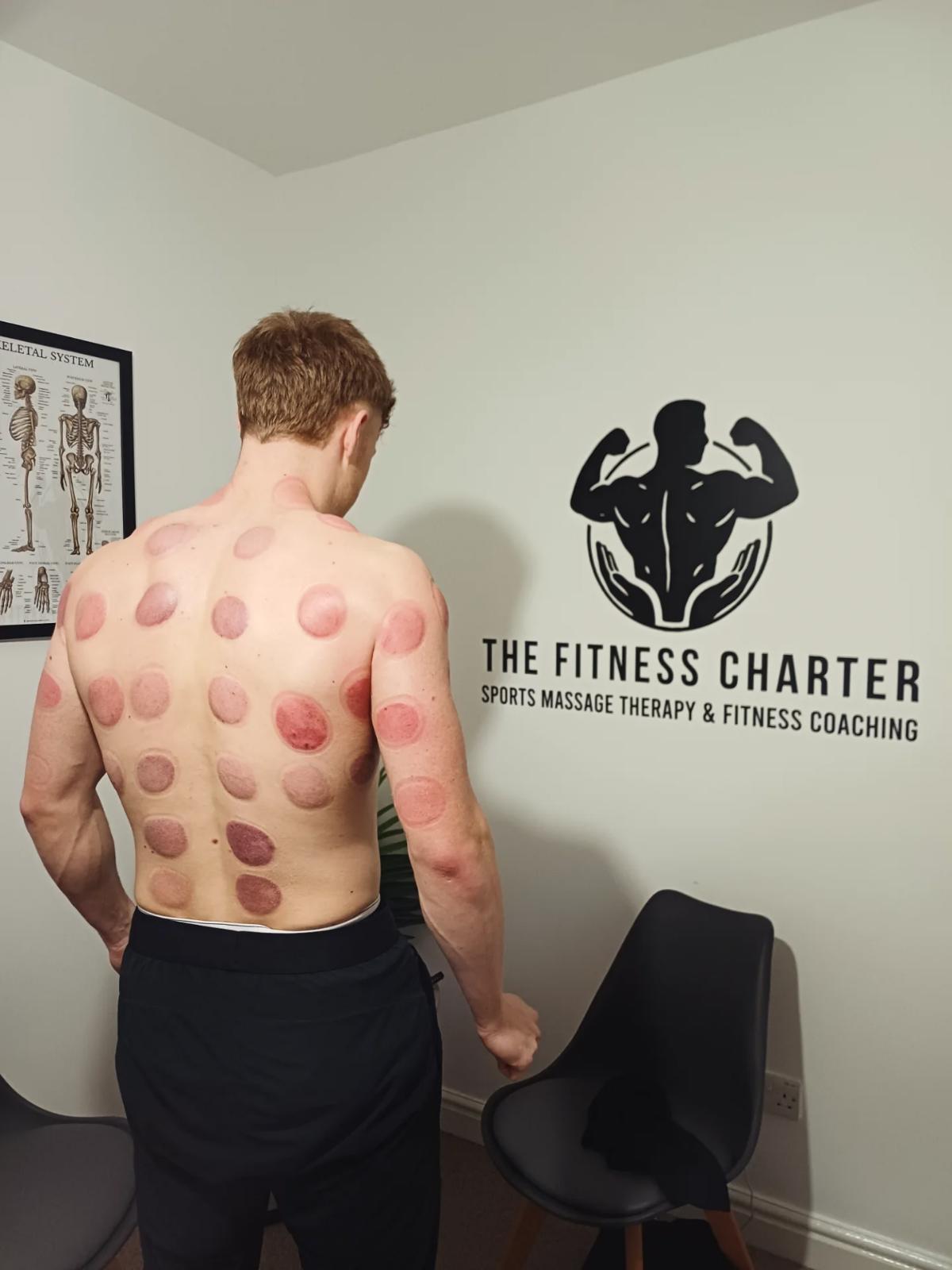 Picture of a client after dry cupping at The Fitness Charter, Merthyr Tydfil